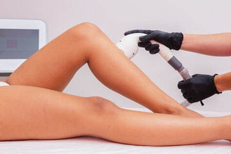 Leg Laser Hair Removal (2)