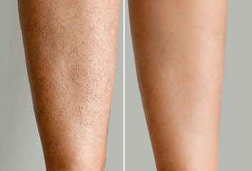 Leg Laser Hair Removal (1)