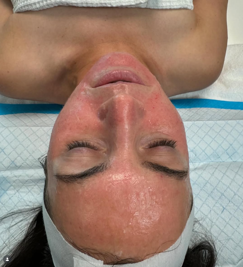 Azelaic Acid Treatment in Clearfield