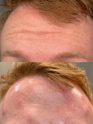 Botox for forehead wrinkles Clearfield