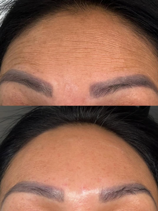 forehead Botox Clearfield UT