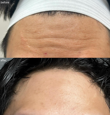 natural lip filler in Clearfield UT