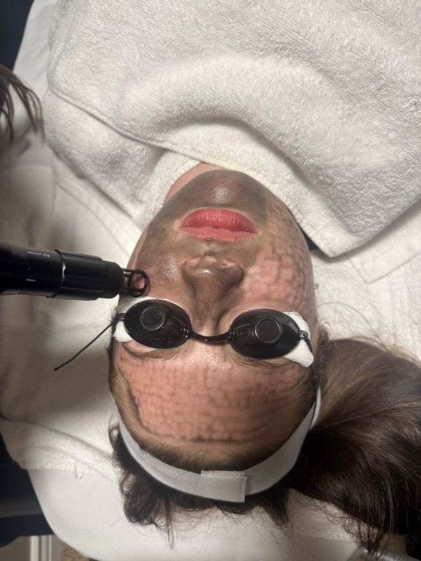 Carbon Facial