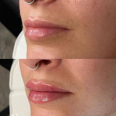 Facial Rejuvenation